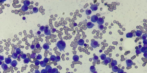 Март – месяц борьбы с множественной миеломой (миеломной болезнью)