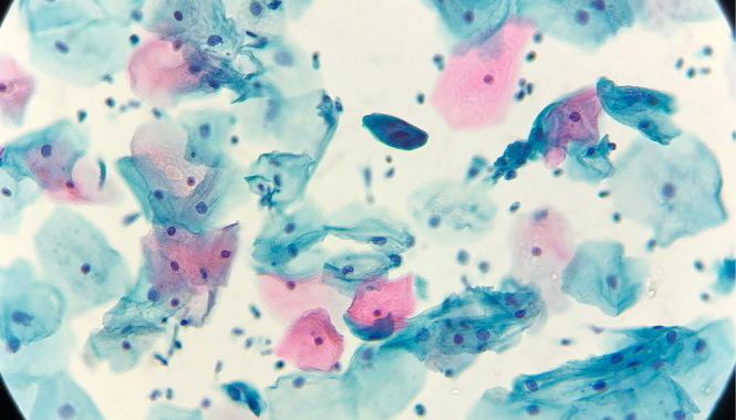 От подготовки до результата: всё о сдаче мазка на онкоцитологию