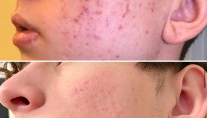 Почему угревую болезнь важно лечить у дерматолога, а не с помощью чисток и диет?