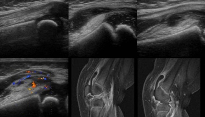 УЗИ коленных суставов