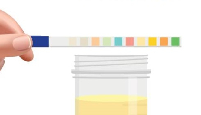 Анализы мочи