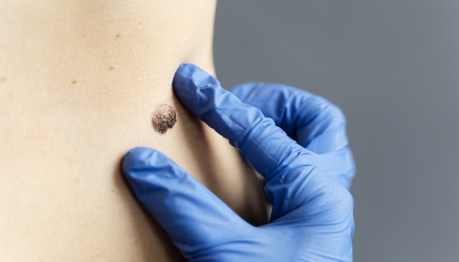 Лазерное удаление новообразований кожи на Елизаровской