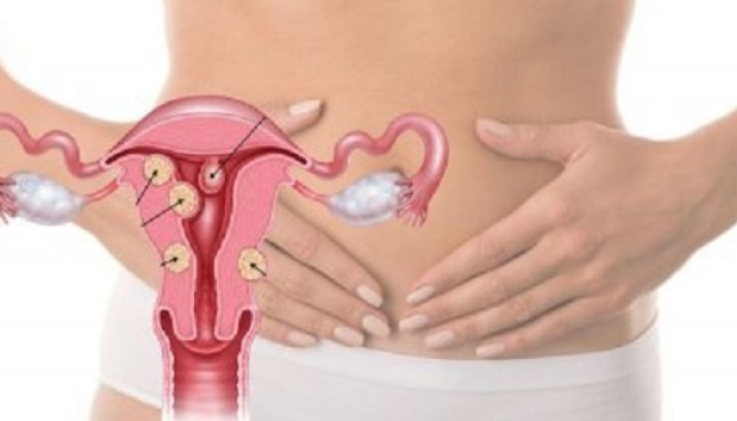 Миома матки