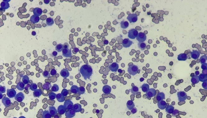 Март – месяц борьбы с множественной миеломой (миеломной болезнью)