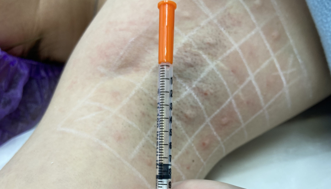 Лечение гипергидроза в МедЛаб