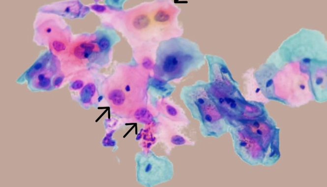 ВПЧ: скрытая угроза, о которой нужно знать