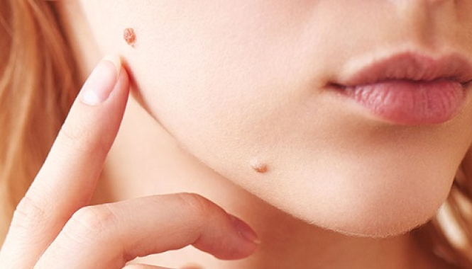 Удаление новообразований