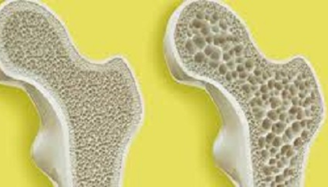 Остеопороз (Лабораторная диагностика)