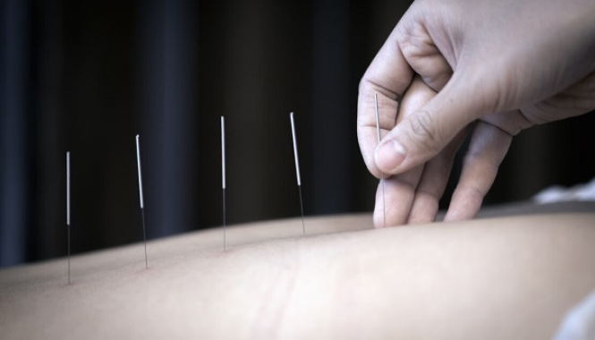 Иглорефлексотерапия