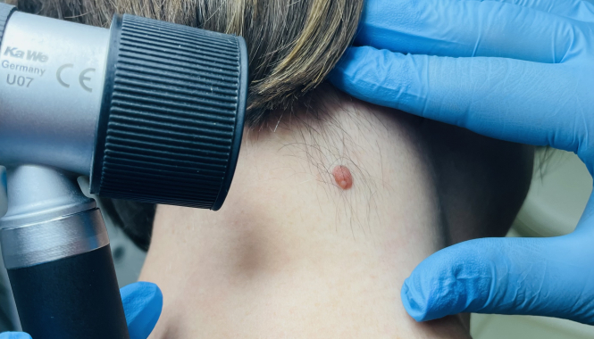 Лазерное удаление новообразований кожи на Елизаровской