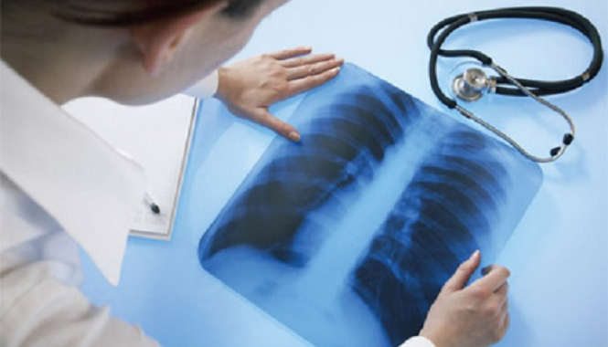 Хроническая обструктивная болезнь легких (ХОБЛ)