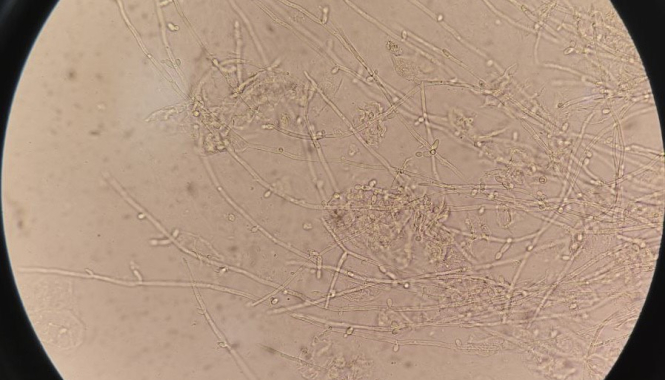 Как избежать ошибок при сдаче мочи и мокроты?