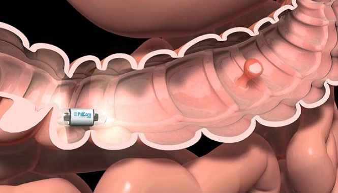 Видеокапсульная эндоскопия