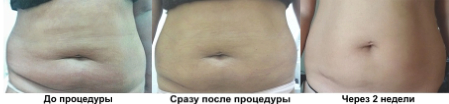 Мезонити на область живота