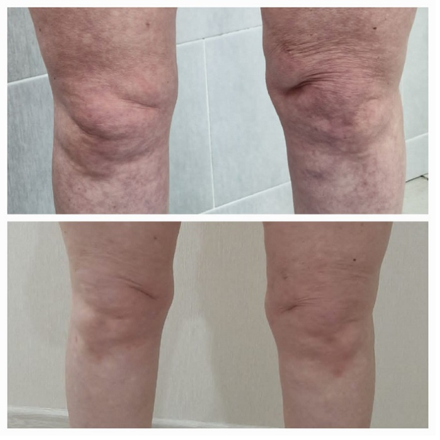 Результат RF-лифтинга ног (1 процедура)