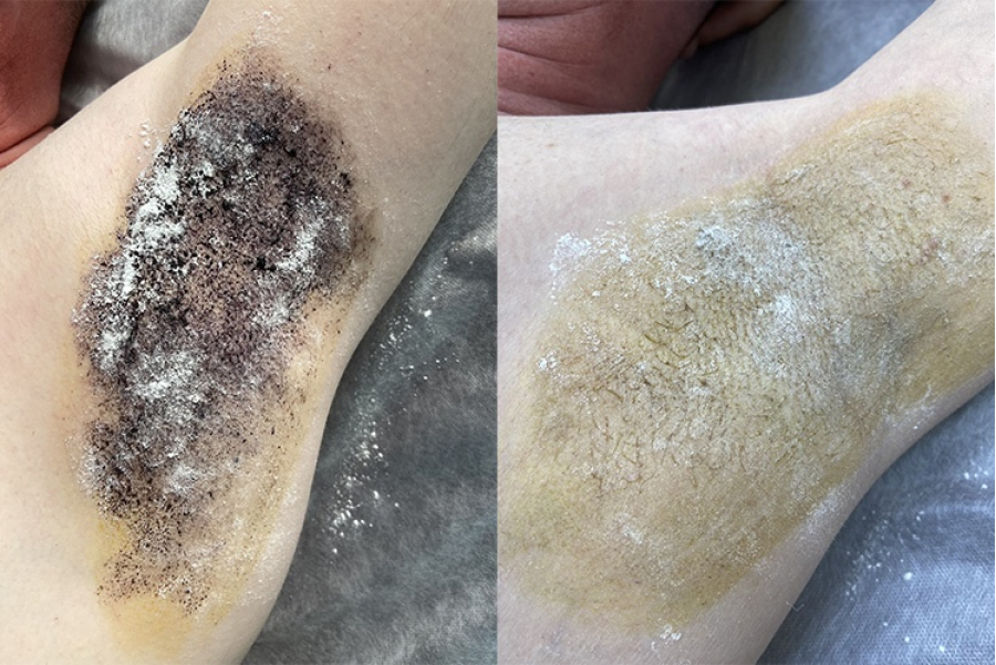 Лечение гипергидроза в МедЛаб