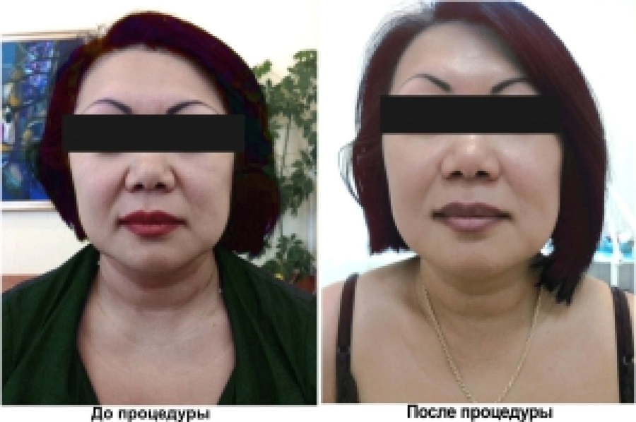Мезонити на лицо