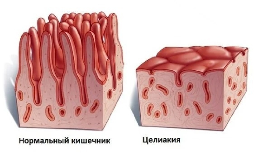 версинки кишечника при целиакии