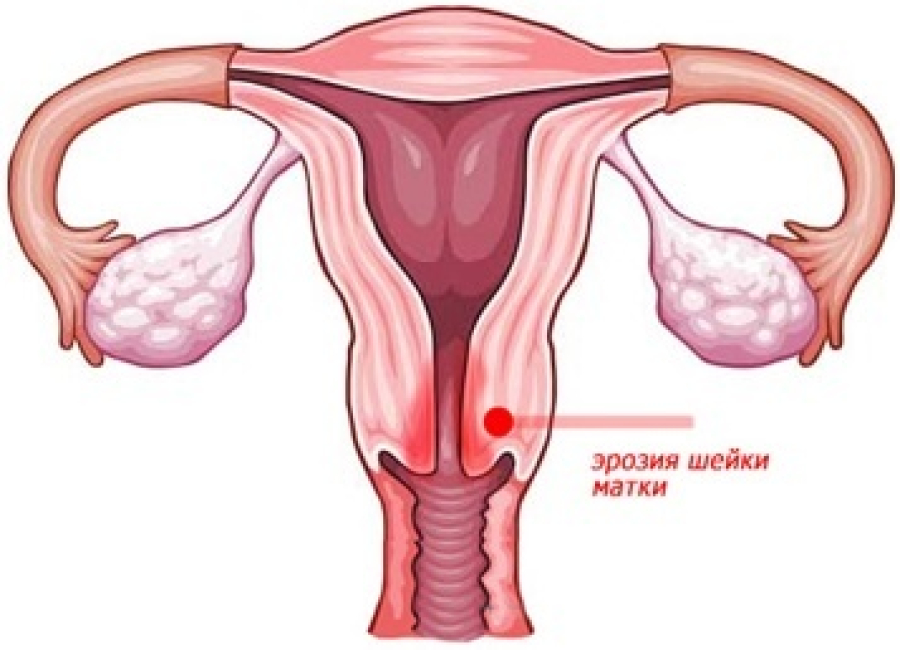 Эрозия шейки матки