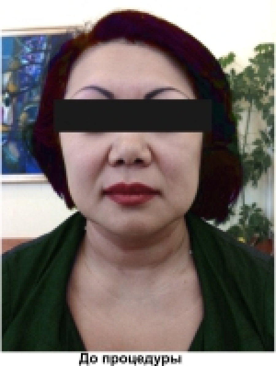 лифтинг мезонитями