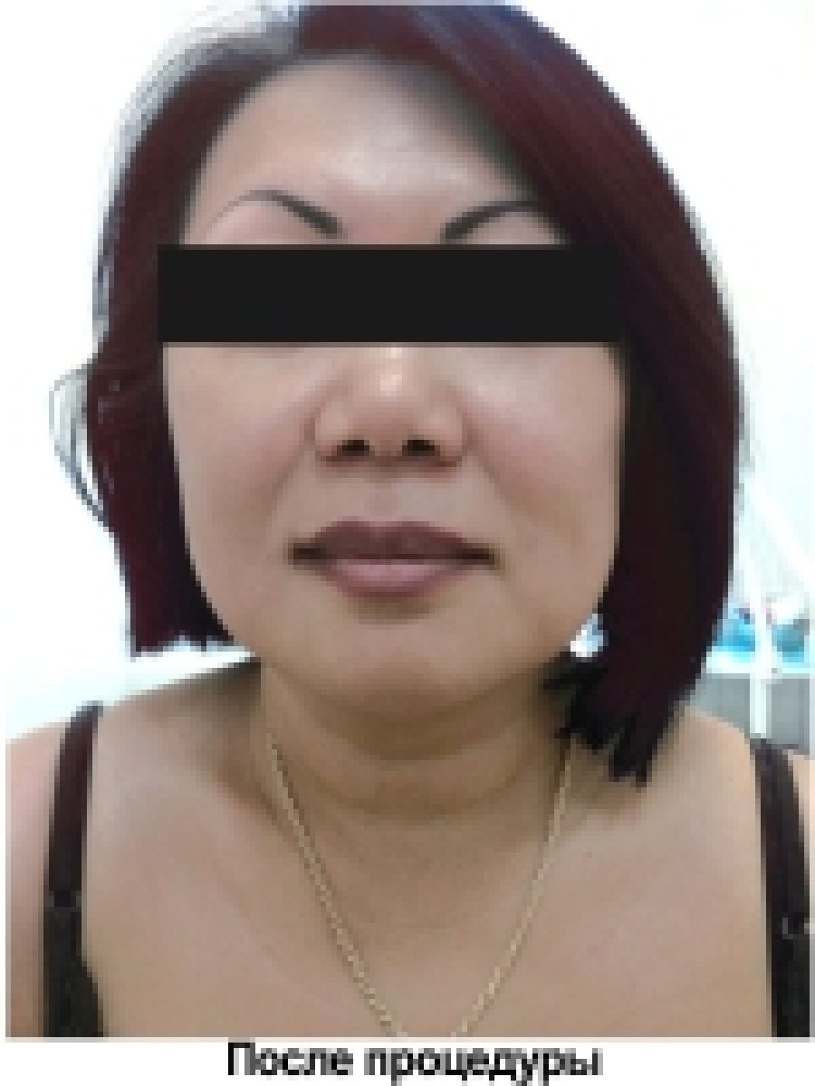 лифтинг мезонитями