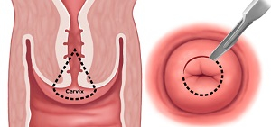 Конизация шейки матки