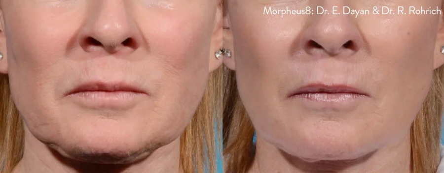 Результат RF-лифтинга нижней трети лица и шеи (2 процедуры)