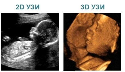 3D-узи при беременности.jpg